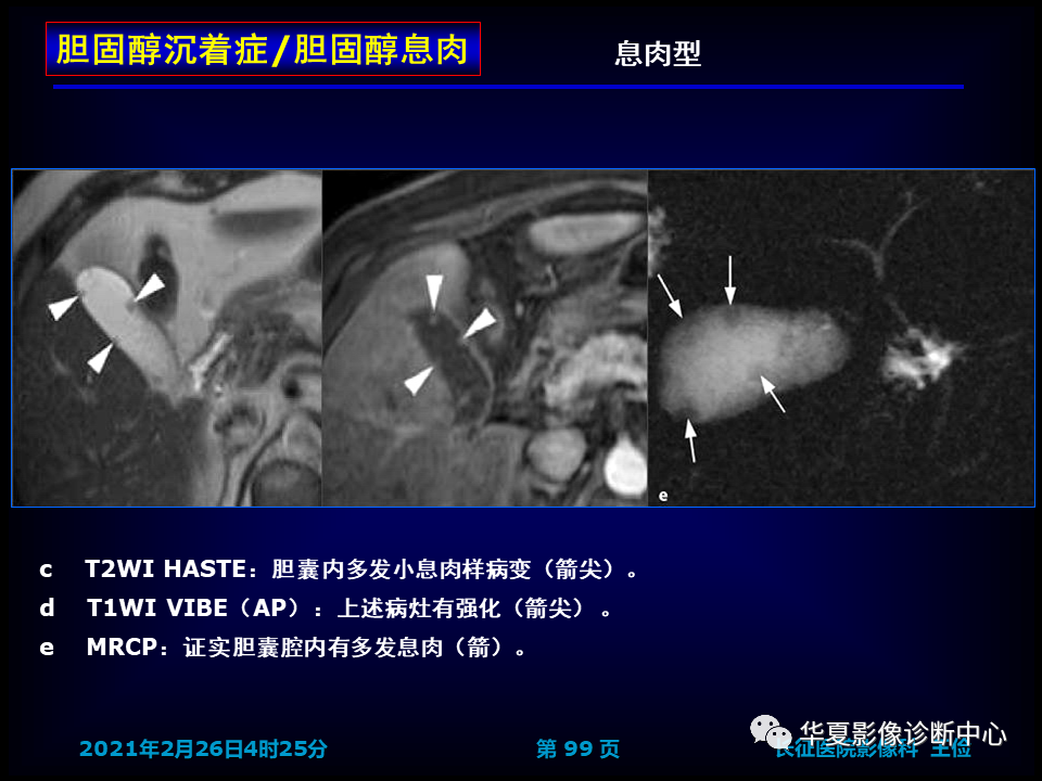 影像PPT - 【病例】坏死性胆囊炎1例MR影像-105