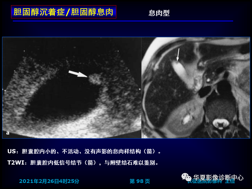 影像PPT - 【病例】坏死性胆囊炎1例MR影像-104