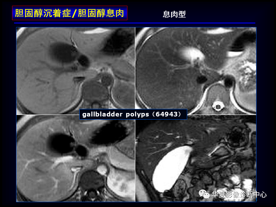 影像PPT - 【病例】坏死性胆囊炎1例MR影像-106