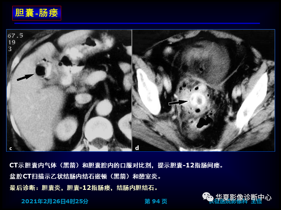 影像PPT - 【病例】坏死性胆囊炎1例MR影像-100