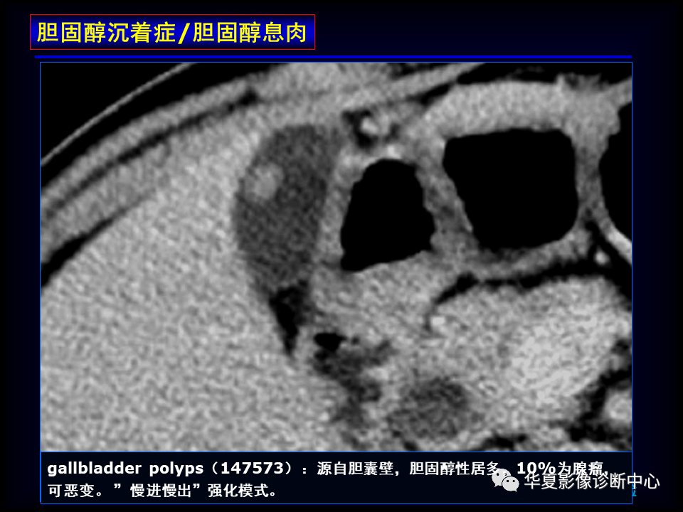 影像PPT - 【病例】坏死性胆囊炎1例MR影像-108