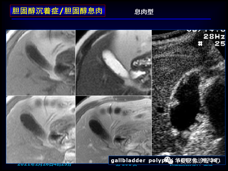 影像PPT - 【病例】坏死性胆囊炎1例MR影像-107