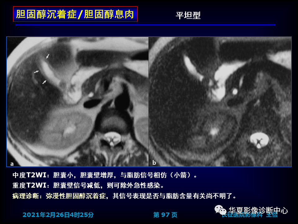 影像PPT - 【病例】坏死性胆囊炎1例MR影像-103