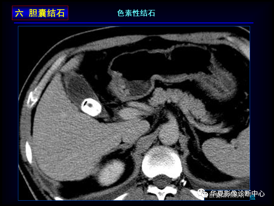影像PPT - 【病例】坏死性胆囊炎1例MR影像-115