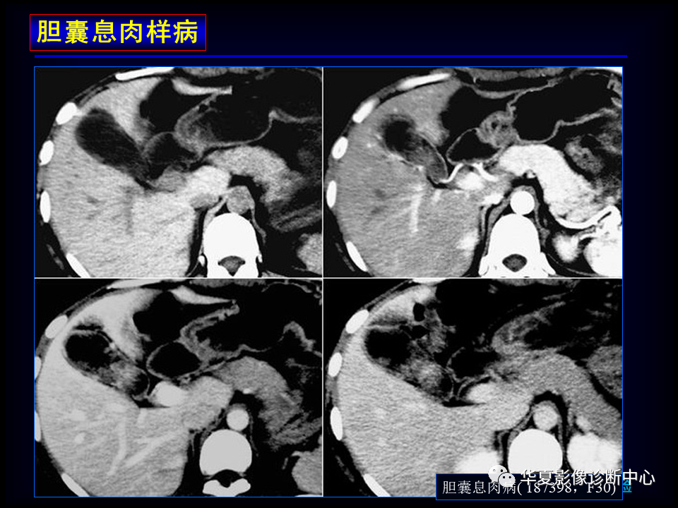 影像PPT - 【病例】坏死性胆囊炎1例MR影像-109
