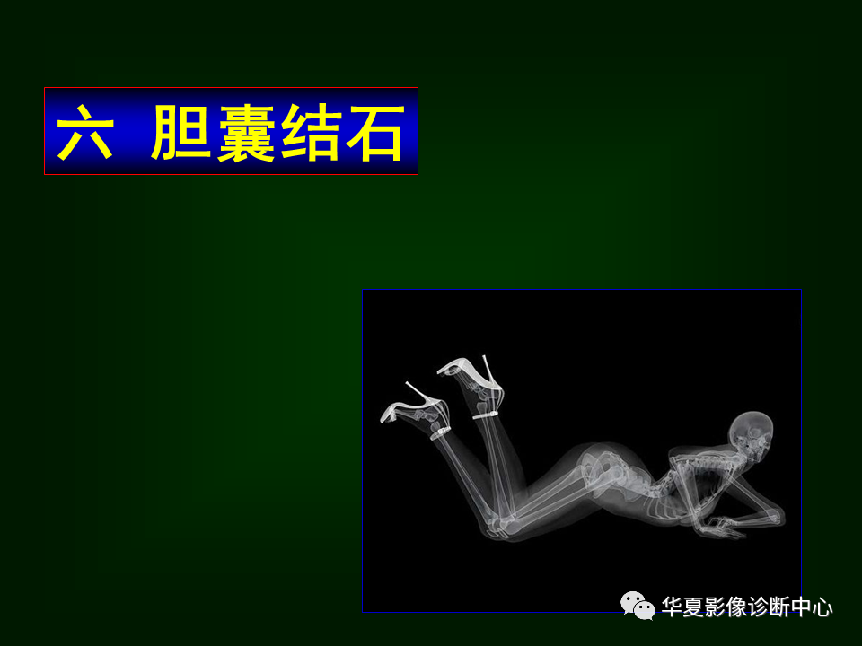 影像PPT - 【病例】坏死性胆囊炎1例MR影像-111