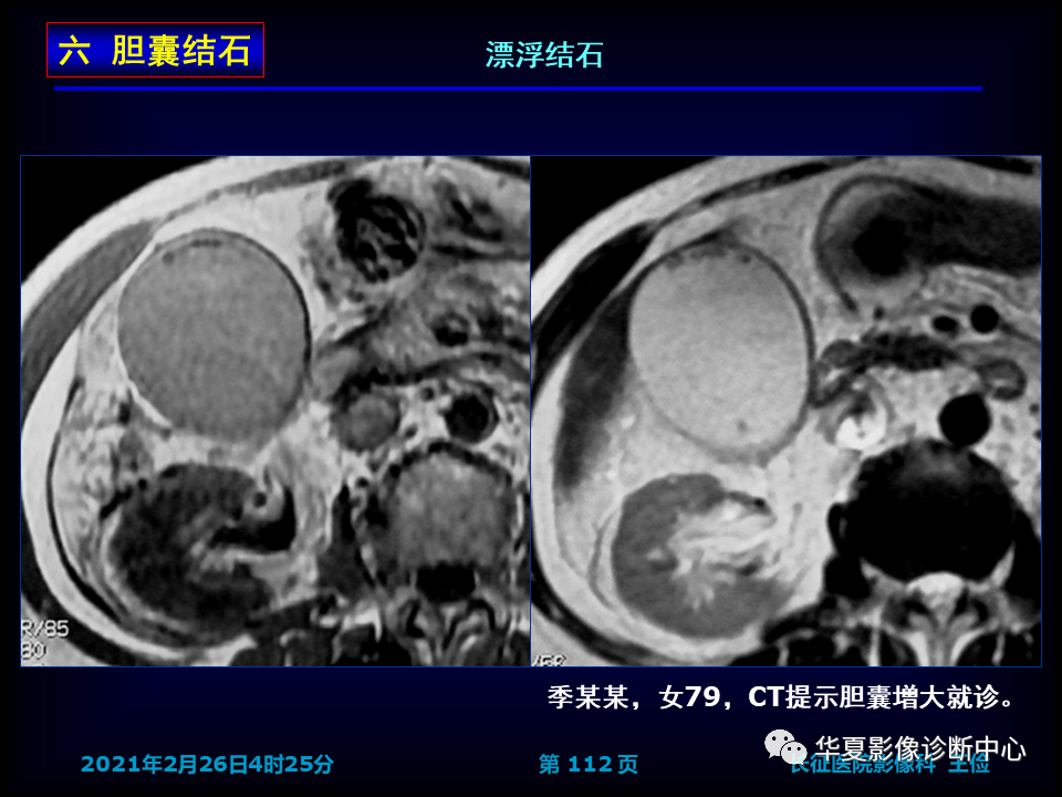 影像PPT - 【病例】坏死性胆囊炎1例MR影像-118