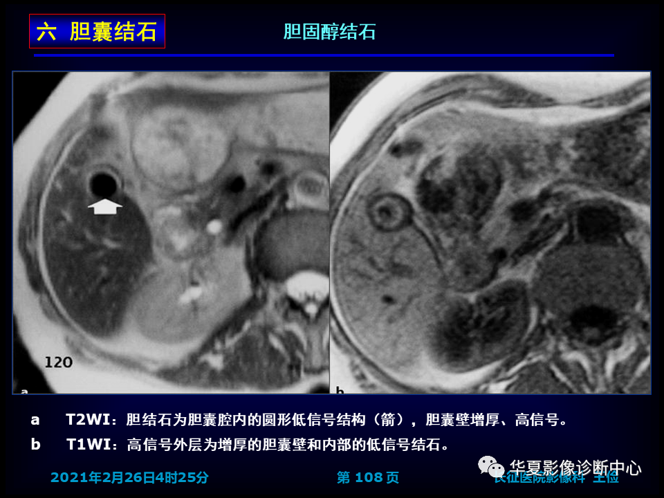 影像PPT - 【病例】坏死性胆囊炎1例MR影像-114