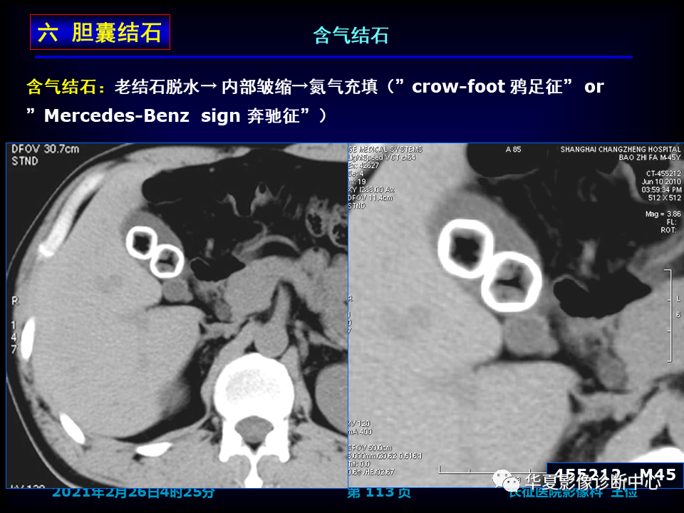 影像PPT - 【病例】坏死性胆囊炎1例MR影像-119