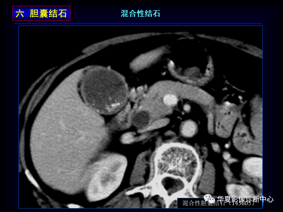 影像PPT - 【病例】坏死性胆囊炎1例MR影像-116