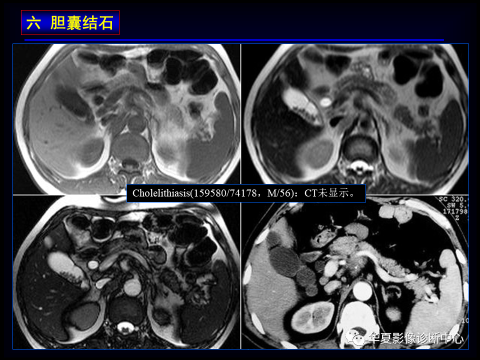 影像PPT - 【病例】坏死性胆囊炎1例MR影像-123