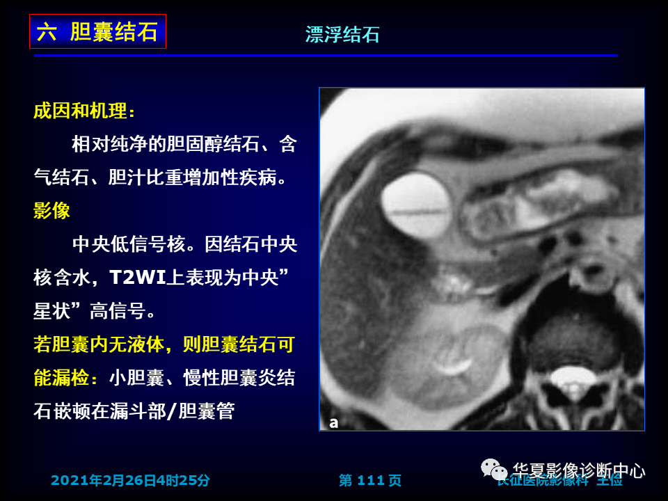 影像PPT - 【病例】坏死性胆囊炎1例MR影像-117