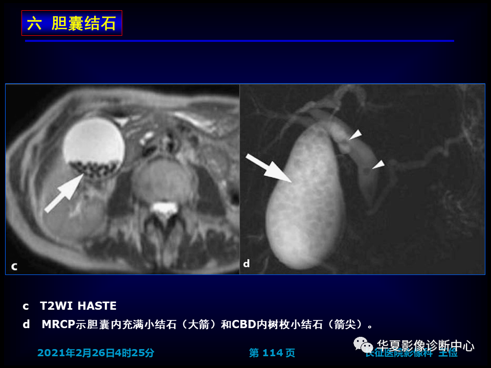 影像PPT - 【病例】坏死性胆囊炎1例MR影像-120