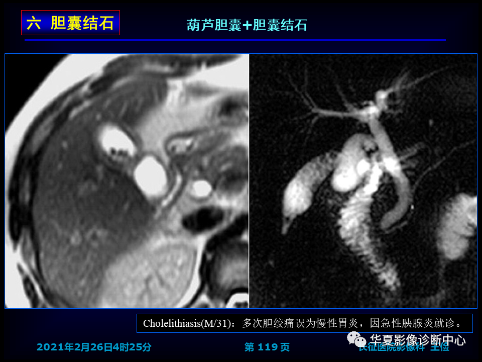 影像PPT - 【病例】坏死性胆囊炎1例MR影像-125