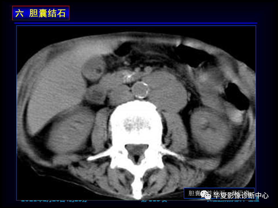 影像PPT - 【病例】坏死性胆囊炎1例MR影像-121