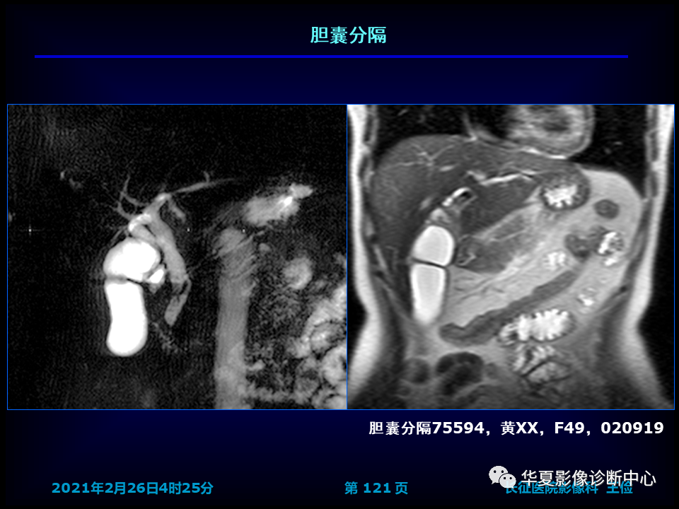 影像PPT - 【病例】坏死性胆囊炎1例MR影像-127