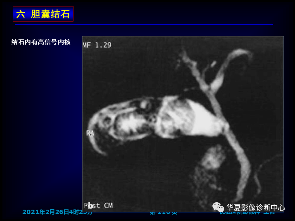 影像PPT - 【病例】坏死性胆囊炎1例MR影像-122