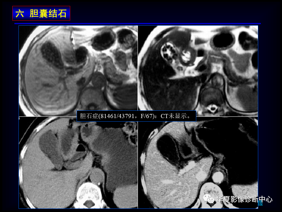影像PPT - 【病例】坏死性胆囊炎1例MR影像-124