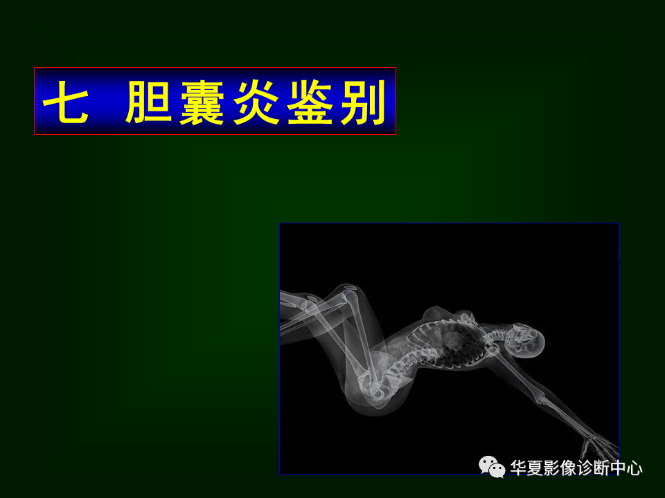 影像PPT - 【病例】坏死性胆囊炎1例MR影像-130