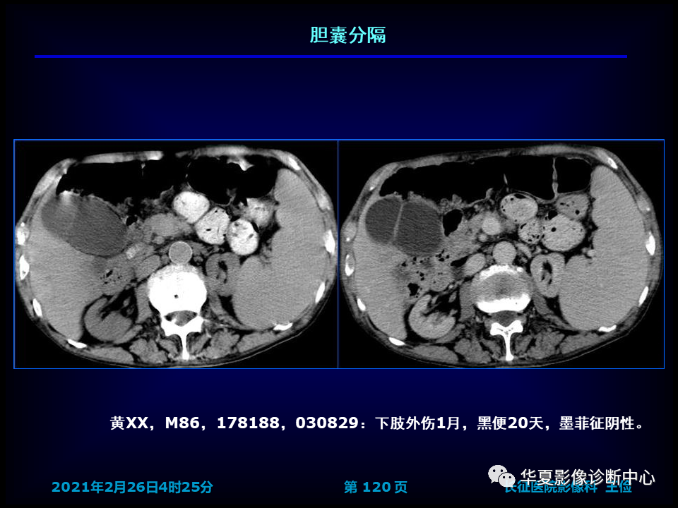 影像PPT - 【病例】坏死性胆囊炎1例MR影像-126