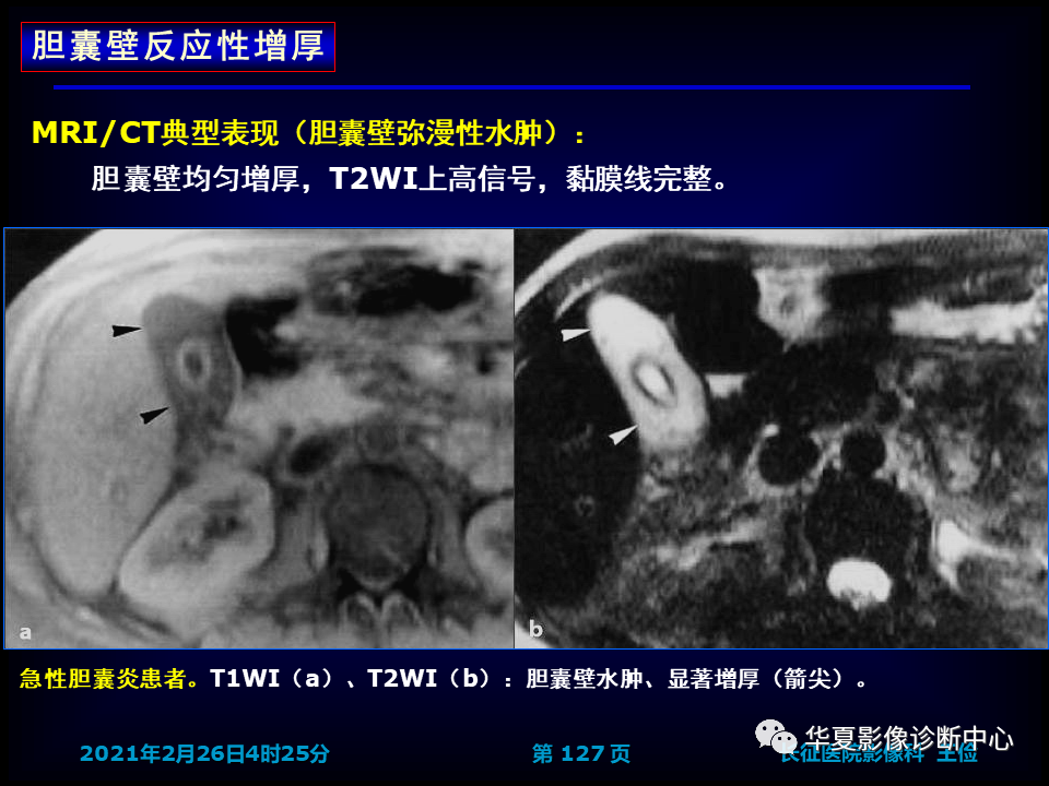 影像PPT - 【病例】坏死性胆囊炎1例MR影像-133