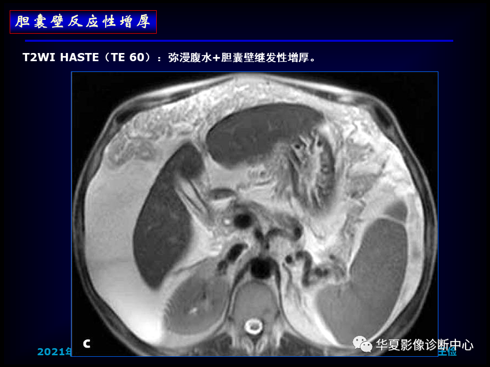 影像PPT - 【病例】坏死性胆囊炎1例MR影像-134