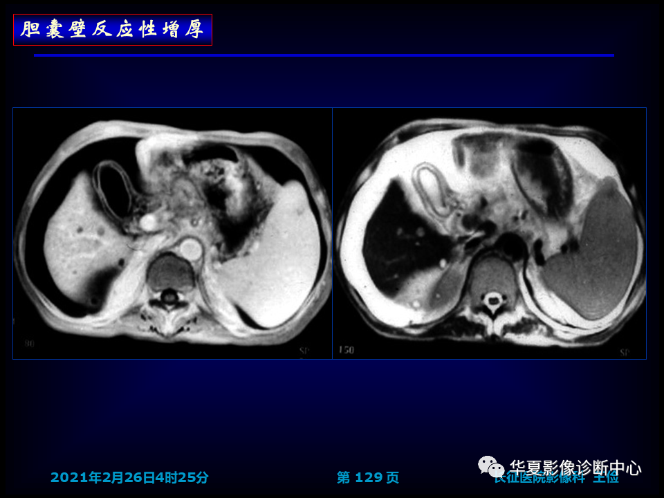 影像PPT - 【病例】坏死性胆囊炎1例MR影像-135