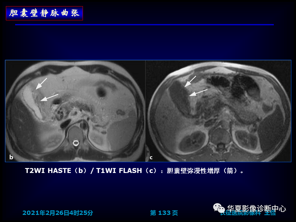 影像PPT - 【病例】坏死性胆囊炎1例MR影像-139