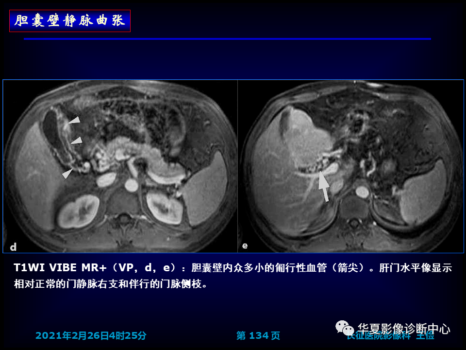 影像PPT - 【病例】坏死性胆囊炎1例MR影像-140