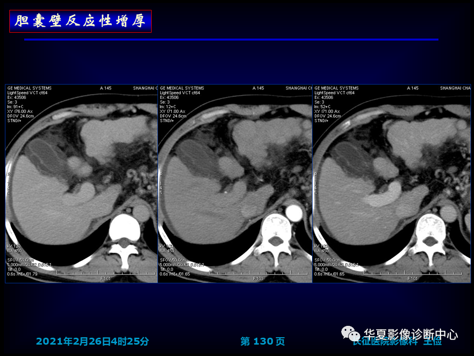 影像PPT - 【病例】坏死性胆囊炎1例MR影像-136