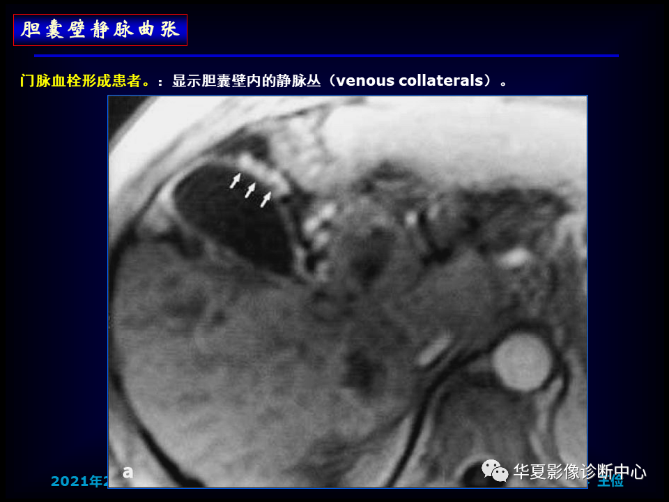 影像PPT - 【病例】坏死性胆囊炎1例MR影像-138