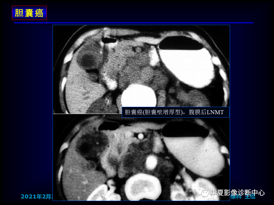 影像PPT - 【病例】坏死性胆囊炎1例MR影像-147