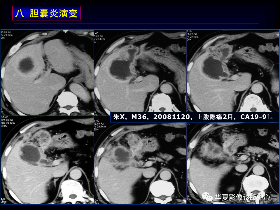 影像PPT - 【病例】坏死性胆囊炎1例MR影像-151