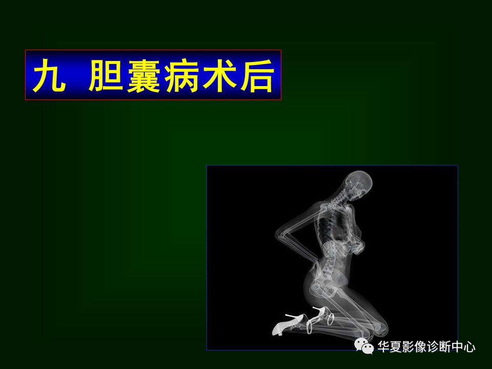 影像PPT - 【病例】坏死性胆囊炎1例MR影像-153