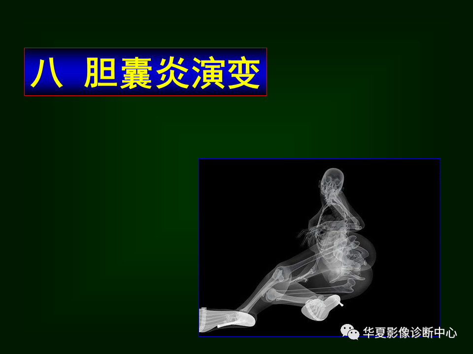 影像PPT - 【病例】坏死性胆囊炎1例MR影像-150