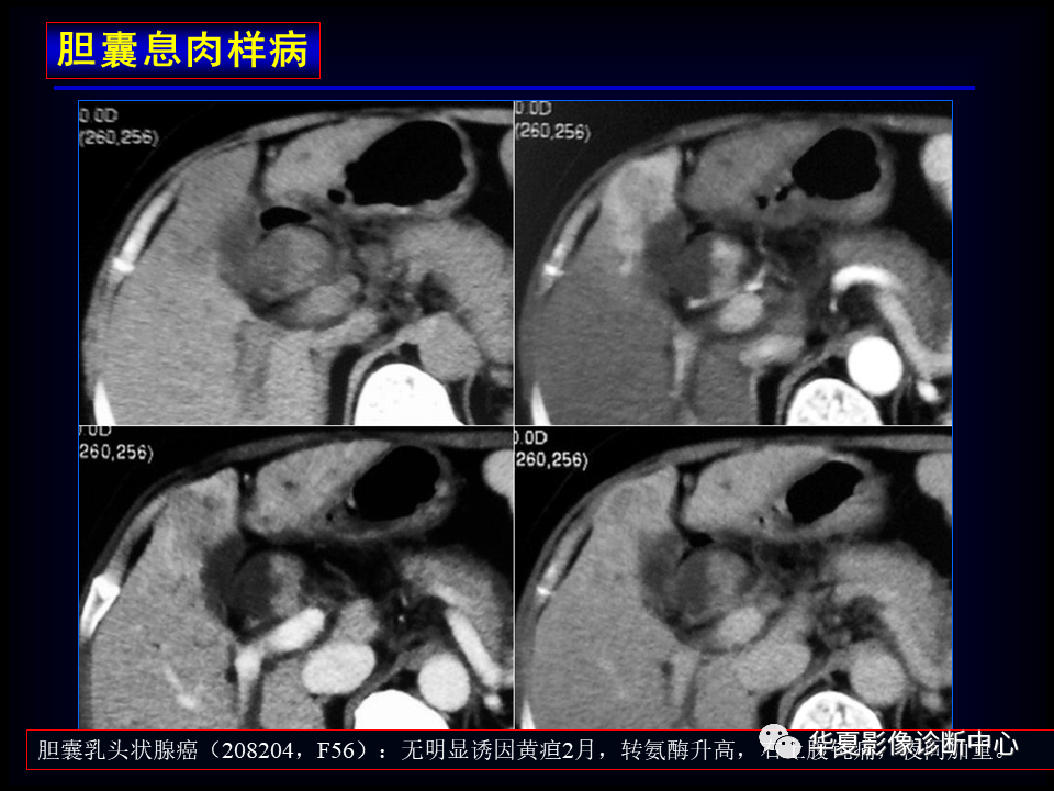 影像PPT - 【病例】坏死性胆囊炎1例MR影像-148
