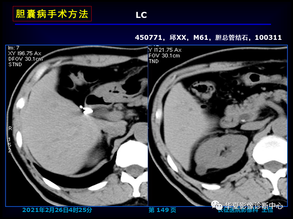 影像PPT - 【病例】坏死性胆囊炎1例MR影像-155