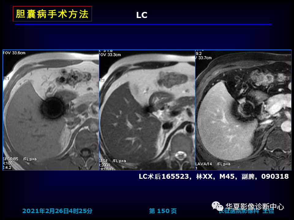 影像PPT - 【病例】坏死性胆囊炎1例MR影像-156