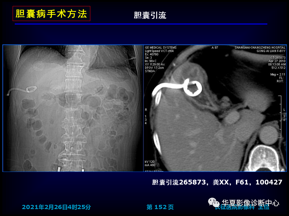 影像PPT - 【病例】坏死性胆囊炎1例MR影像-158