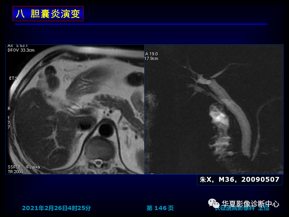 影像PPT - 【病例】坏死性胆囊炎1例MR影像-152