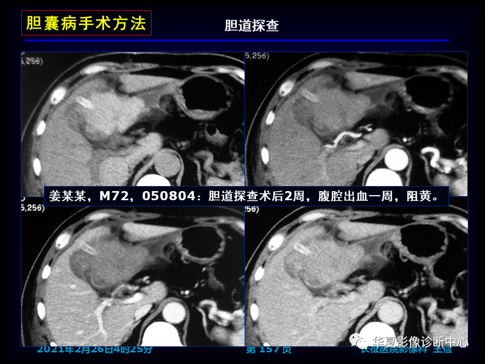 影像PPT - 【病例】坏死性胆囊炎1例MR影像-163