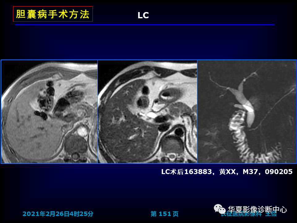影像PPT - 【病例】坏死性胆囊炎1例MR影像-157