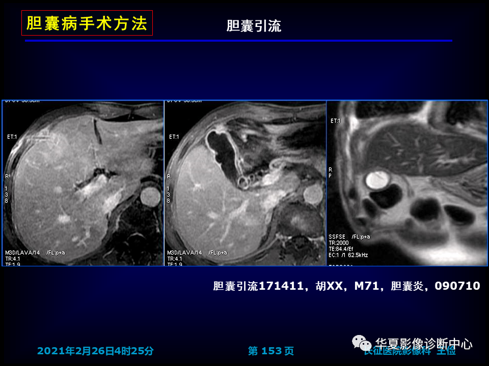 影像PPT - 【病例】坏死性胆囊炎1例MR影像-159