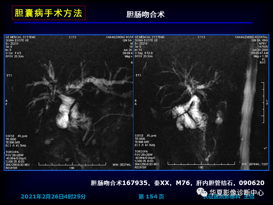 影像PPT - 【病例】坏死性胆囊炎1例MR影像-160
