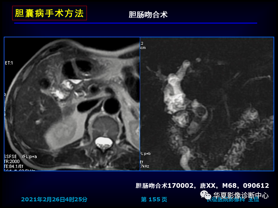 影像PPT - 【病例】坏死性胆囊炎1例MR影像-161