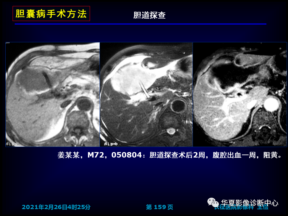 影像PPT - 【病例】坏死性胆囊炎1例MR影像-165