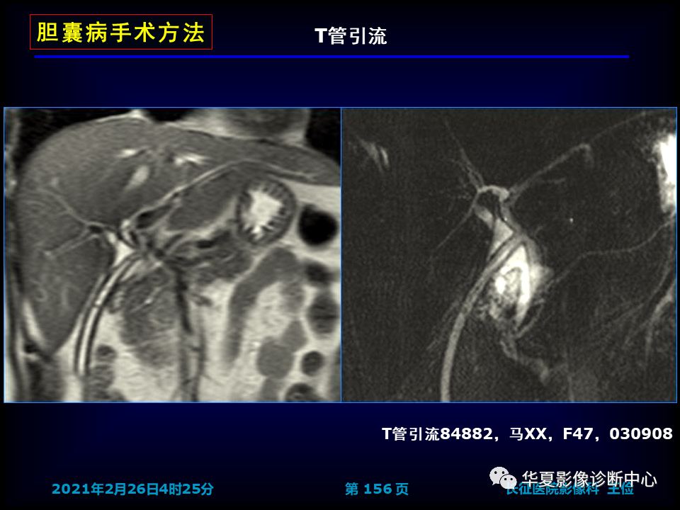 影像PPT - 【病例】坏死性胆囊炎1例MR影像-162