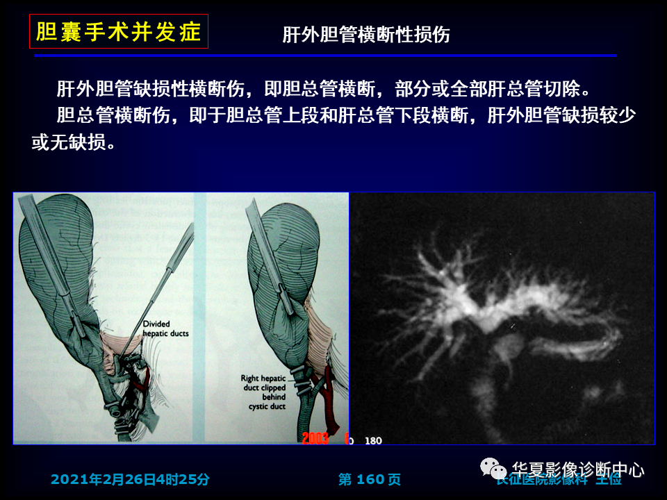 影像PPT - 【病例】坏死性胆囊炎1例MR影像-166