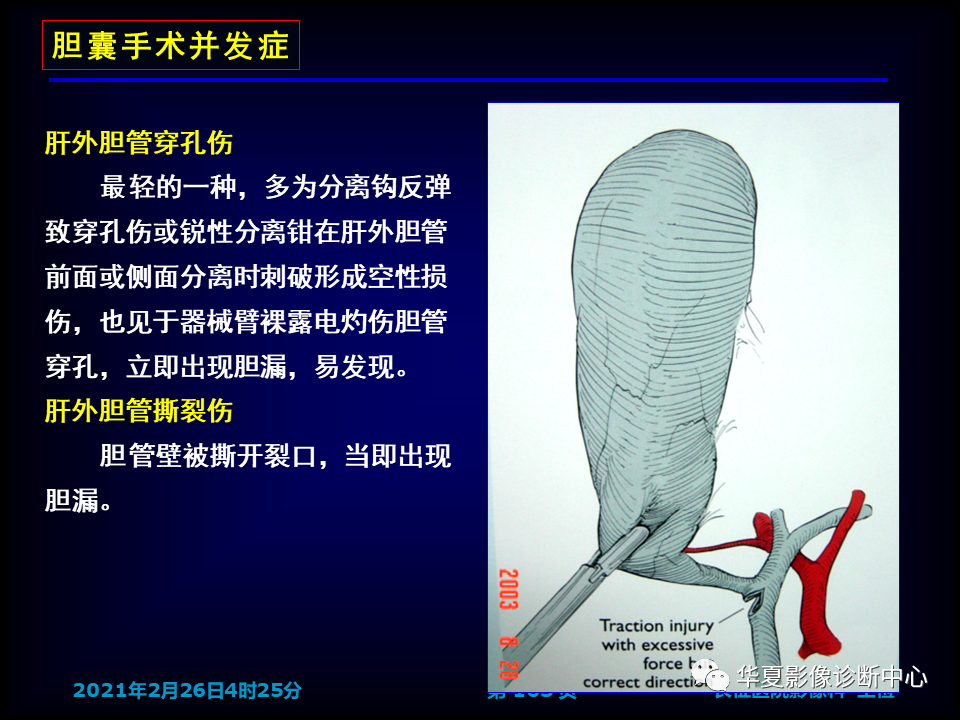 影像PPT - 【病例】坏死性胆囊炎1例MR影像-169