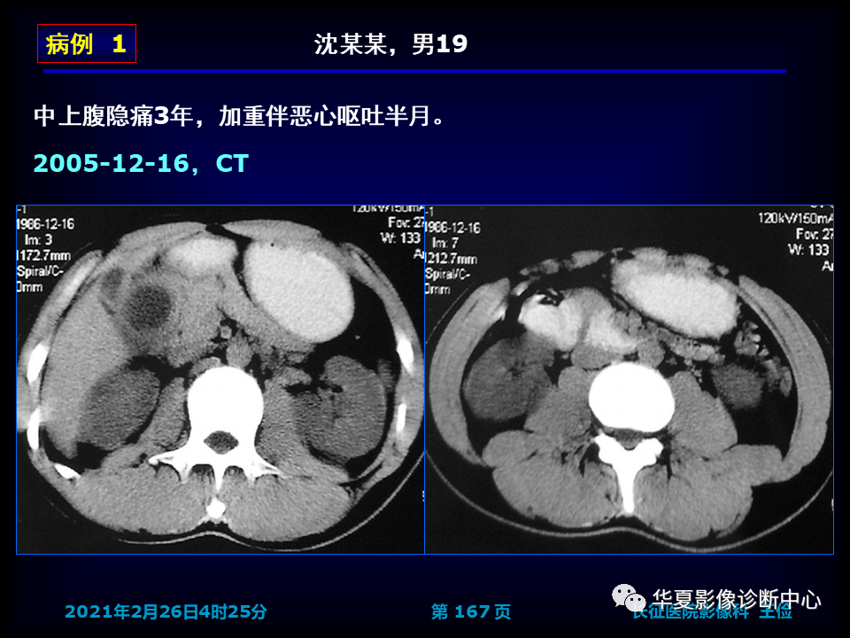 影像PPT - 【病例】坏死性胆囊炎1例MR影像-173